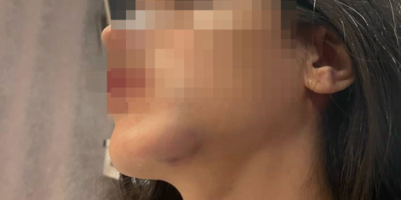 Eski sevgili dehşeti: Genç kadın tuzağa çekildiğini söyledi, darp fotoğraflarını paylaştı